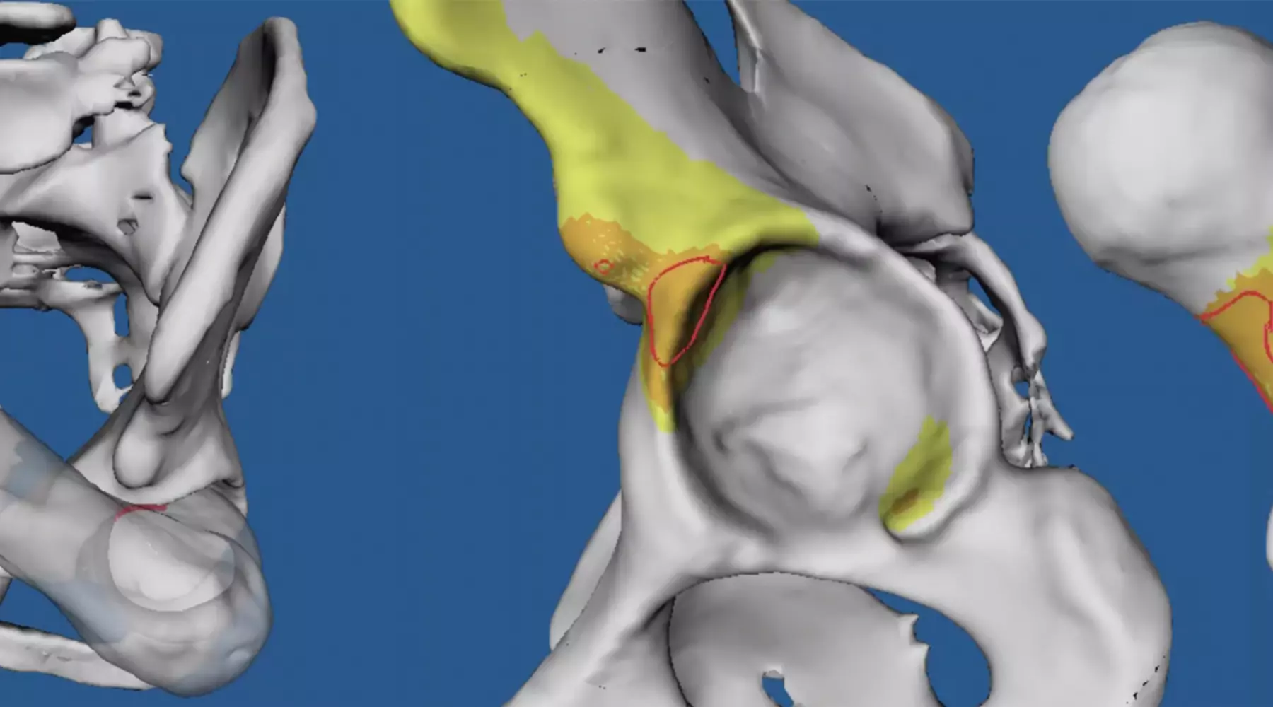 Ein Animationsvideo eines Hüftgelenkes in 3D ermöglicht eine viel genauere Diagnostik oder liefert Information über den Knorpelstatus