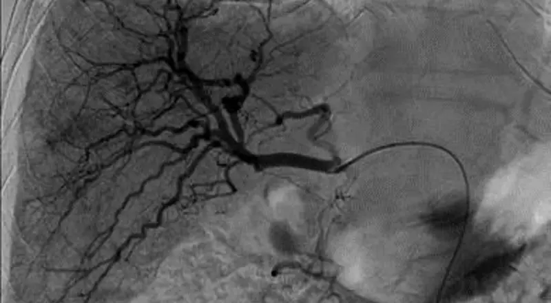 Angiografie der Leber vor der Behandlung mit einem Chemotherapeutikum, das direkt in die tumorversorgenden Arterien verabreicht wird.