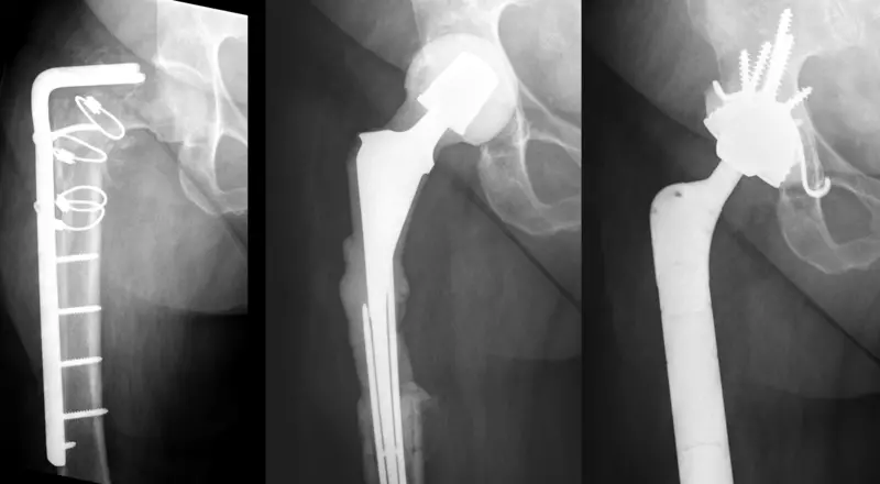 Ostéosynthèse infectée