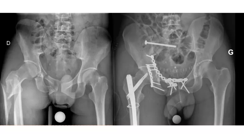 Osteosynthese Polytrauma